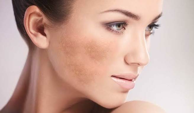 melasma