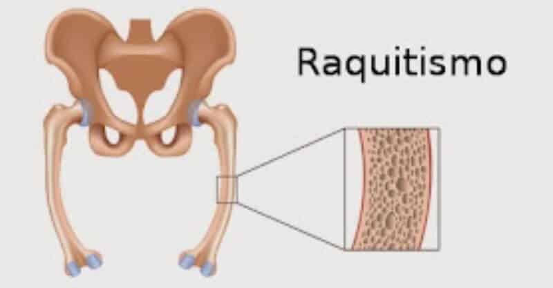 Imagem ilustrativa do raquitismo