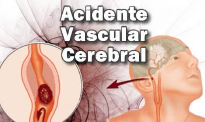 Ilustração de um AVC