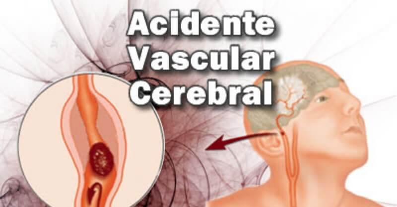 Ilustração de um AVC