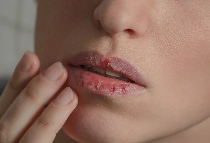 labios ressecados