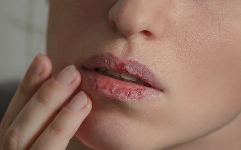 labios ressecados