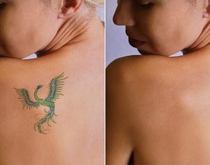 tatuagens remocao